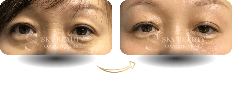 Eye Bag Removal | Removal of Eye Bags | Skybeautyclinic
