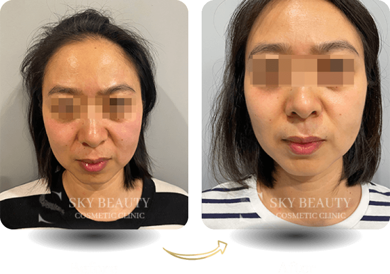 ultherapy before after