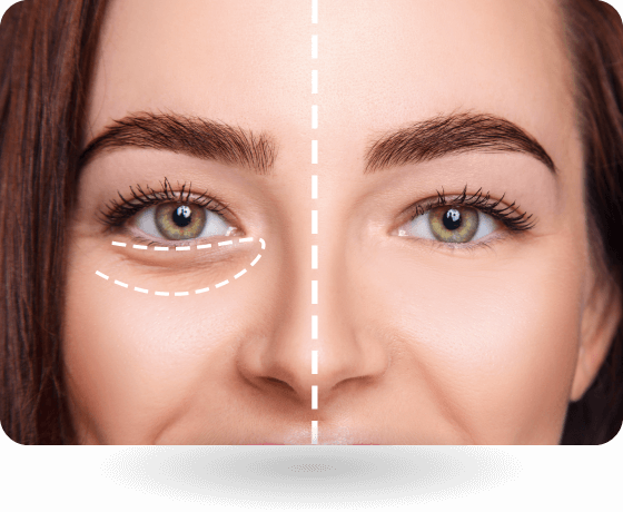 Eye Bag Removal using FOTONA 4D Pro Laser treatment
