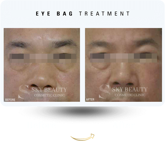 eyebag treatment
